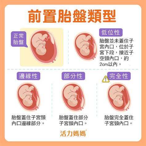 前置胎盤剝離 天運五行查詢